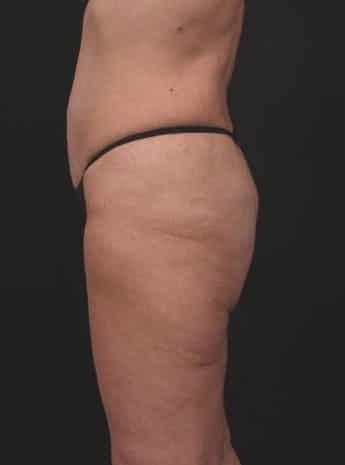 Before Image: Inner and Outer Thigh Lift - left-side