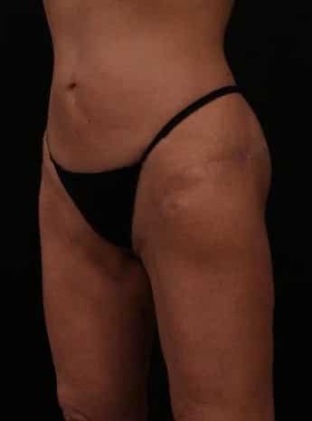 After Image: Inner and Outer Thigh Lift - left-front-oblique