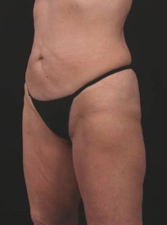 Before Image: Inner and Outer Thigh Lift - left-front-oblique