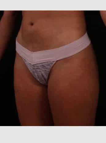 After Image: Liposuction - left-front-oblique