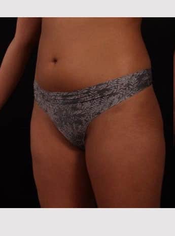 Before Image: Liposuction - left-front-oblique