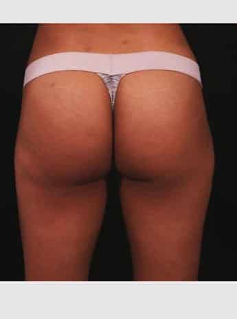 After Image: Liposuction - back