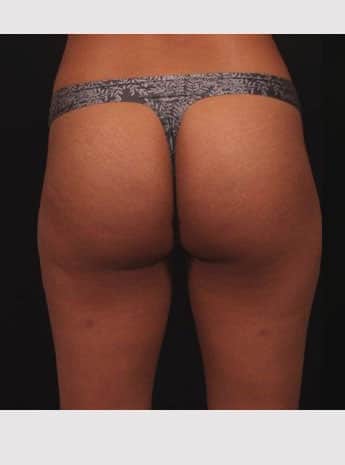 Before Image: Liposuction - back
