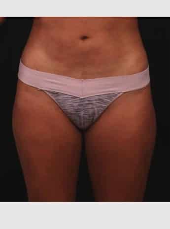 After Image: Liposuction - front