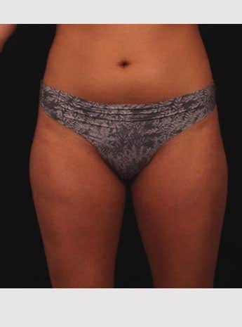 Before Image: Liposuction - front