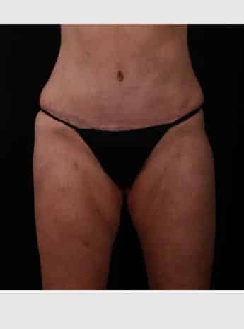 After Image: Tummy Tuck (Abdominoplasty) - front