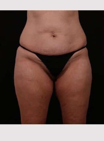 Before Image: Tummy Tuck (Abdominoplasty) - front