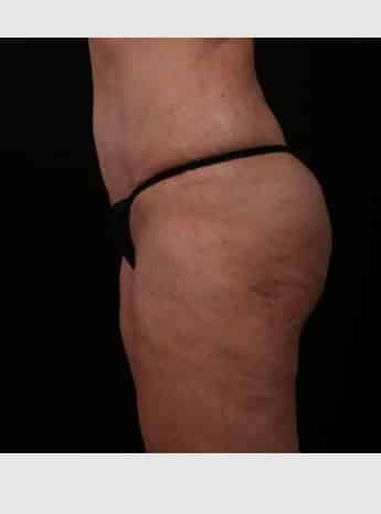 After Image: Tummy Tuck (Abdominoplasty) - left-side
