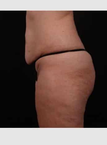 Before Image: Tummy Tuck (Abdominoplasty) - left-side