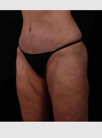 After Image: Tummy Tuck (Abdominoplasty) - left-front-oblique
