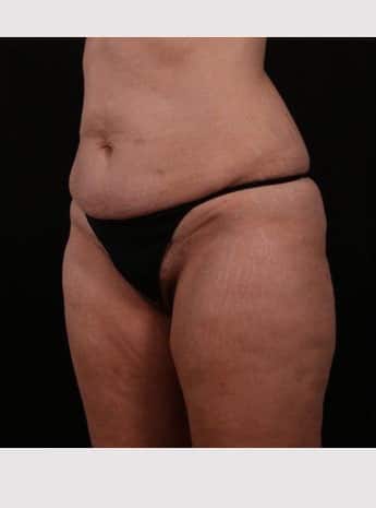 Before Image: Tummy Tuck (Abdominoplasty) - left-front-oblique