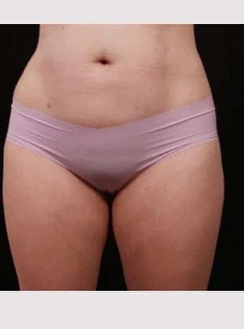 After Image: Liposuction - front