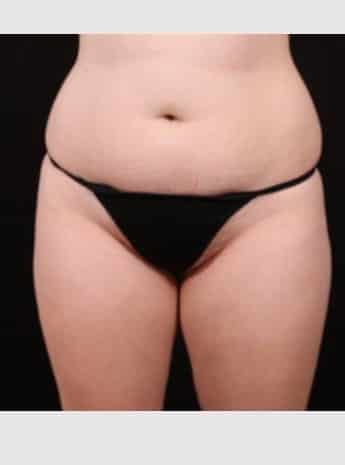 Before Image: Liposuction - front
