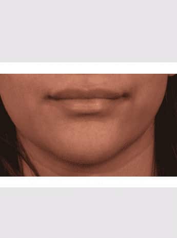 After Image: Lip Lift - front