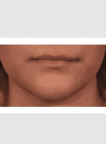 Before Image: Lip Lift - front
