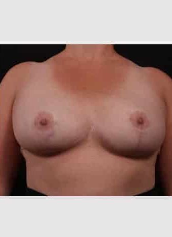 After Image: Breast Reduction - front