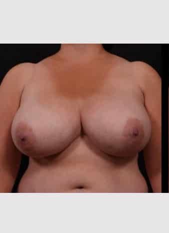 Before Image: Breast Reduction - front