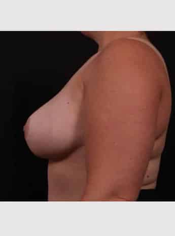 After Image: Breast Reduction - left-side