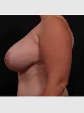 Before Image: Breast Reduction - left-side