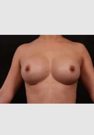 After Image: Breast Augmentation - front
