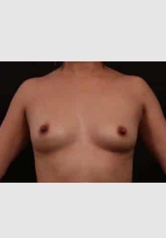 Before Image: Breast Augmentation - front