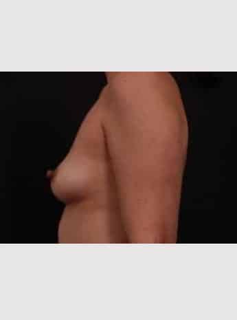 Before Image: Breast Augmentation - left-side