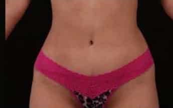 After Image: Tummy Tuck (Abdominoplasty) - front