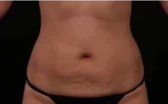 Before Image: Tummy Tuck (Abdominoplasty) - front