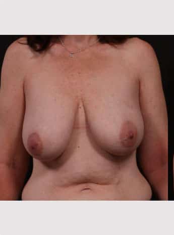 Before Image: Mastopexy (Breast Lift) - front