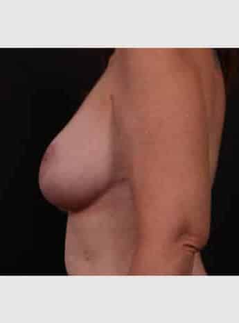After Image: Mastopexy (Breast Lift) - left-side