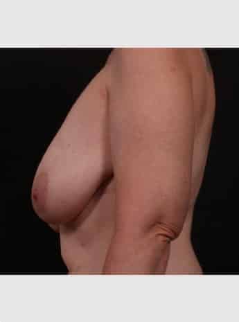 Before Image: Mastopexy (Breast Lift) - left-side