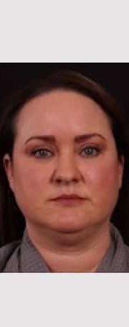 Before Image: Neck Liposuction - front