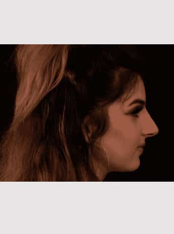After Image: Nonsurgical Rhinoplasty - right-side