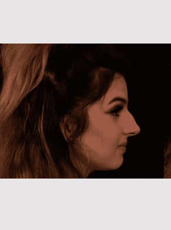 Before Image: Nonsurgical Rhinoplasty - right-side