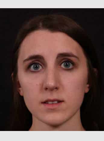 After Image: Rhinoplasty - front