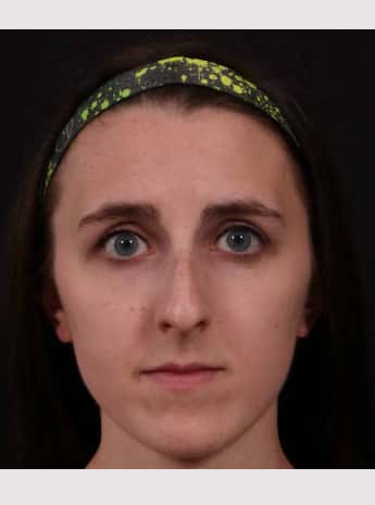 Before Image: Rhinoplasty - front