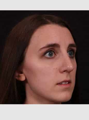 After Image: Rhinoplasty - right-front-oblique