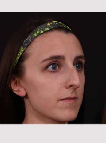 Before Image: Rhinoplasty - right-front-oblique