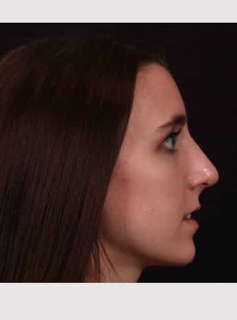 After Image: Rhinoplasty - right-side
