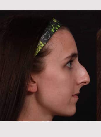 Before Image: Rhinoplasty - right-side