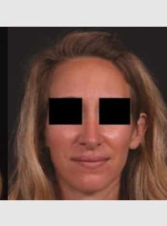 After Image: Rhinoplasty - front