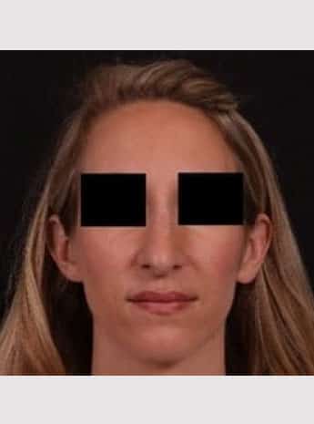 Before Image: Rhinoplasty - front
