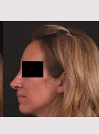After Image: Rhinoplasty - left-side