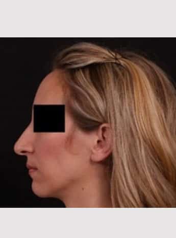 Before Image: Rhinoplasty - left-side