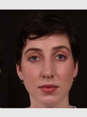 After Image: Rhinoplasty - front