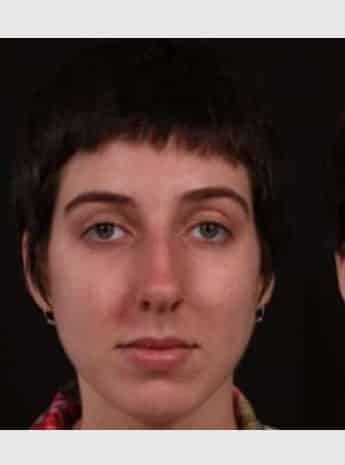 Before Image: Rhinoplasty - front