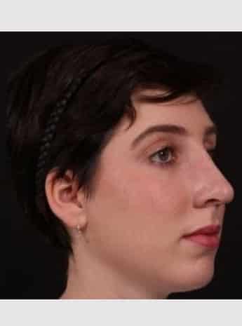After Image: Rhinoplasty - right-front-oblique