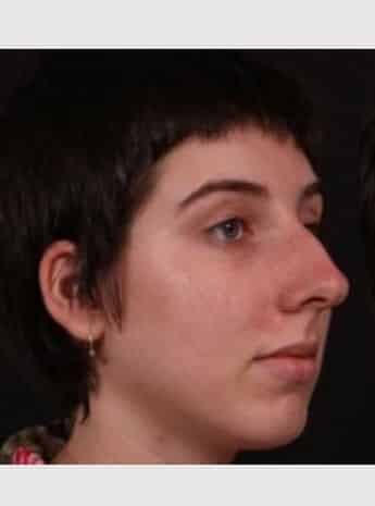 Before Image: Rhinoplasty - right-front-oblique