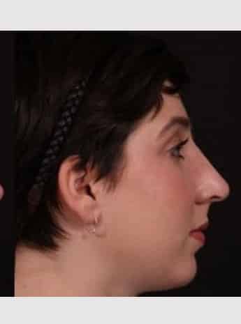 After Image: Rhinoplasty - right-side
