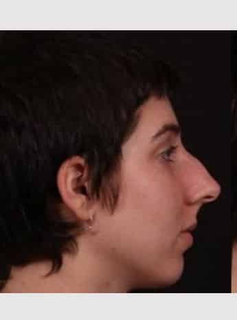 Before Image: Rhinoplasty - right-side